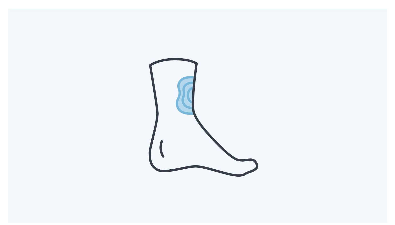 Foot with ankle bruise